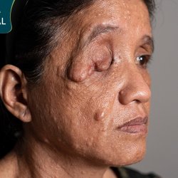 Người phụ nữ sống chung với đa u sợi thần kinh 50 năm được tìm lại ánh sáng tại JW
