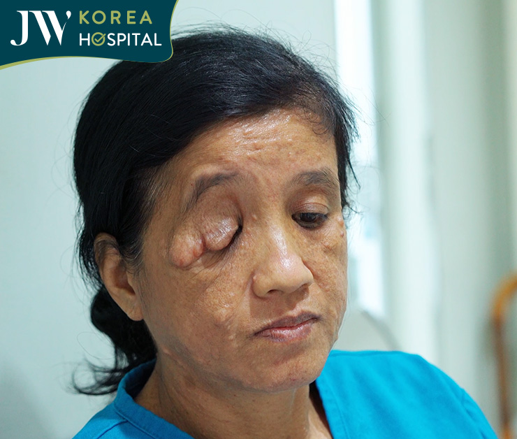 Cô Bé Phương bị nhiều nơi từ chối vì khối u phức tạp