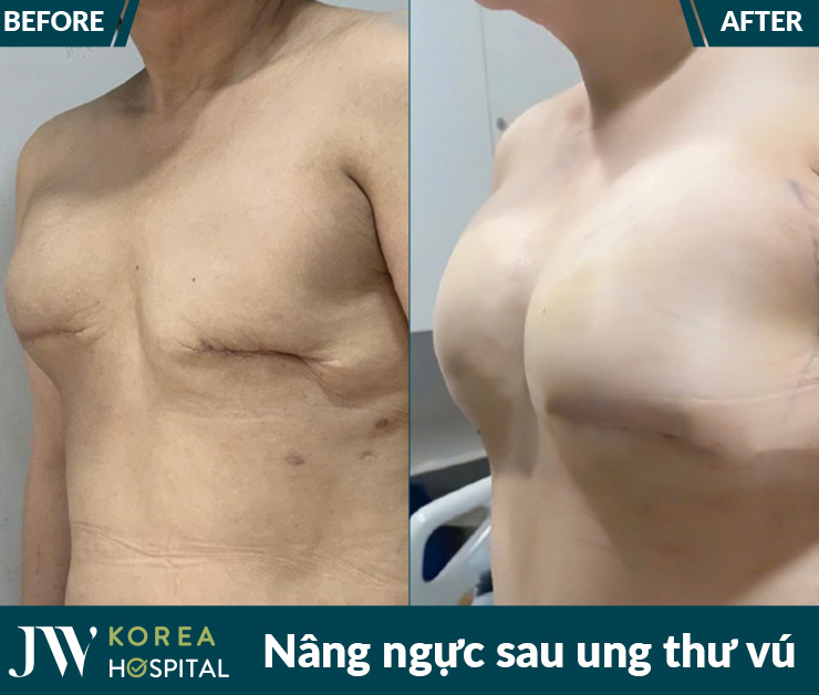 Kết quả nâng ngực điều trị cho bệnh nhân ung thư vú tại Bệnh viện JW