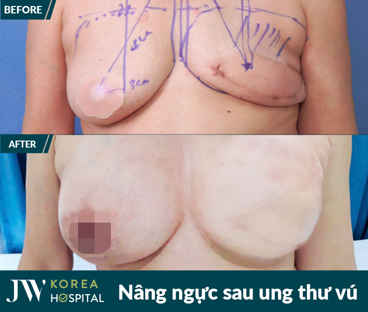Hình ảnh trước và sau điều trị ung thư vú tại bệnh viện JW