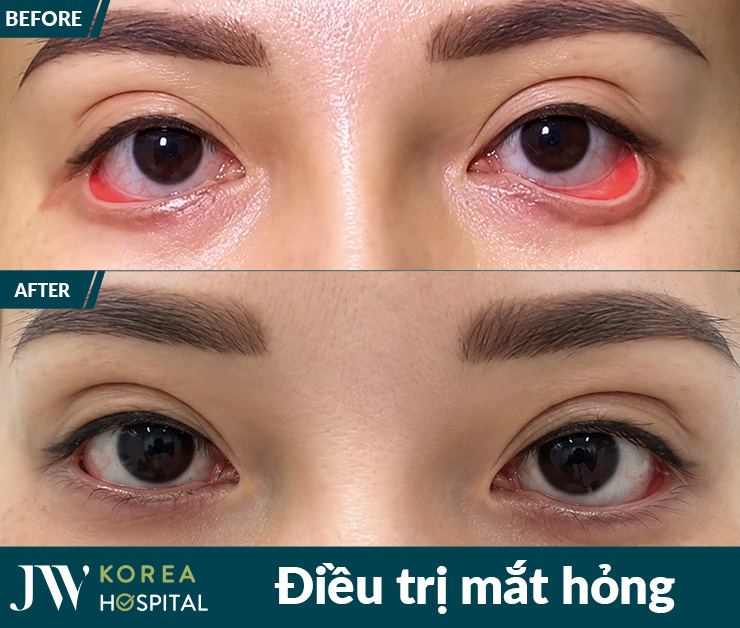 kết quả trước và sau điều trị mắt hỏng tại jw