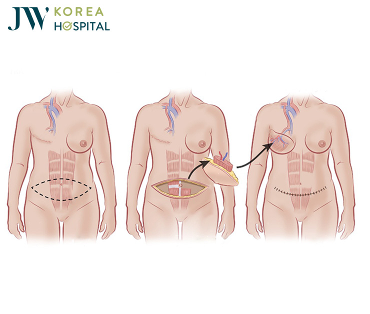 Phương pháp nâng ngực bằng kỹ thuật chuyển vạt cơ bụng tại bệnh viện JW 