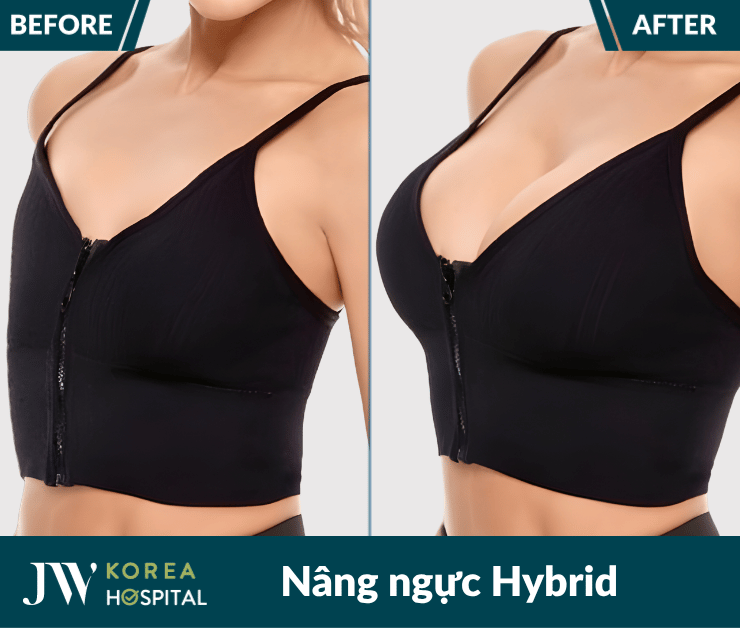 Phương pháp nâng ngực bằng kỹ thuật Hybrid tại bệnh viện JW