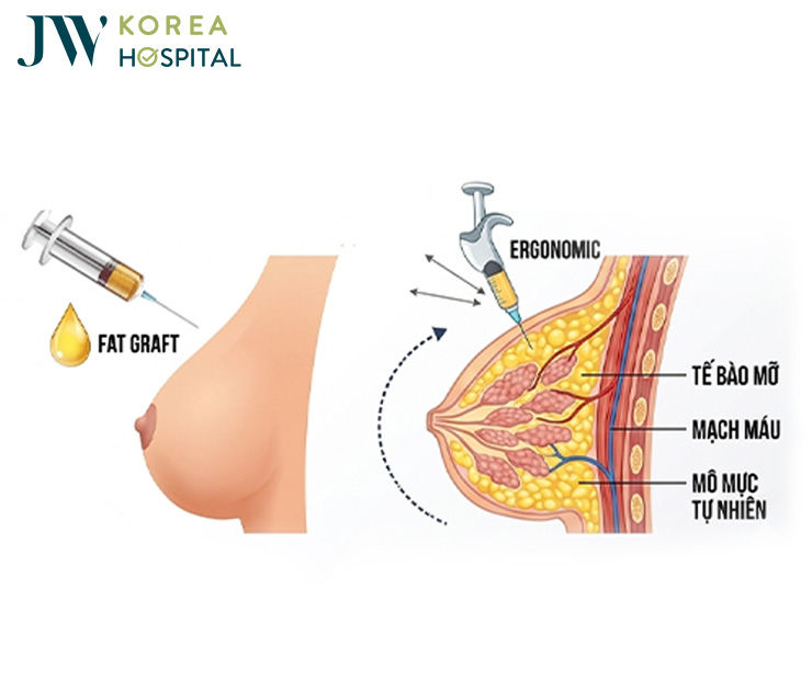 Nâng ngực bằng mỡ tự thân tại bệnh viện JW