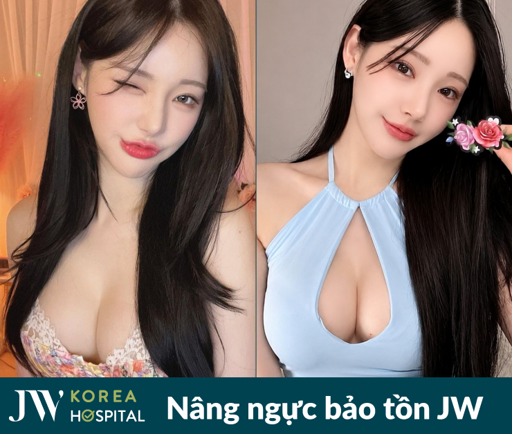 Hình ảnh khách hàng trước và sau nâng ngực bảo tồn tại Bệnh viện JW